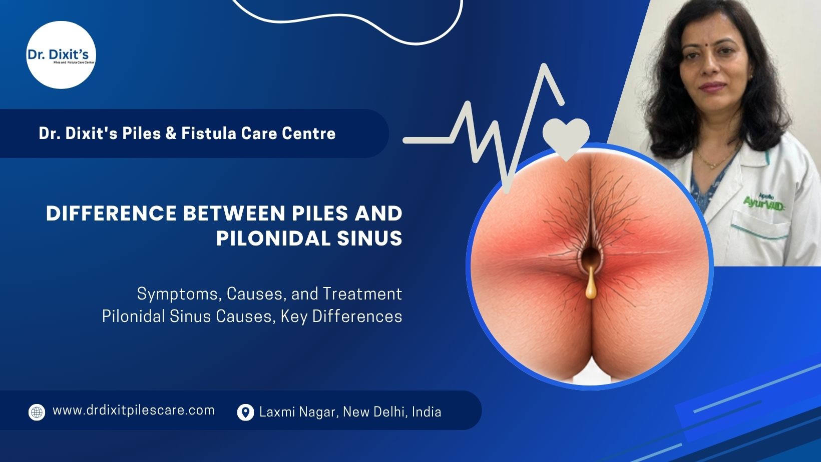 8 Common Differences Between Piles and Pilonidal Sinus