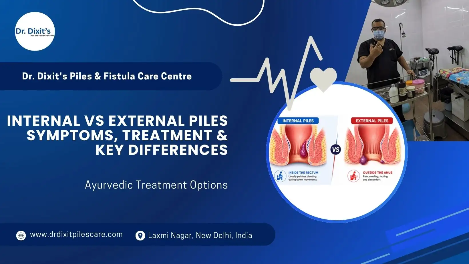 Internal vs External Piles Symptoms, Treatment & Key Differences