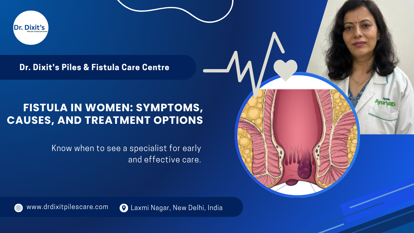 Fistula in Women: Symptoms, Causes, and Treatment Options