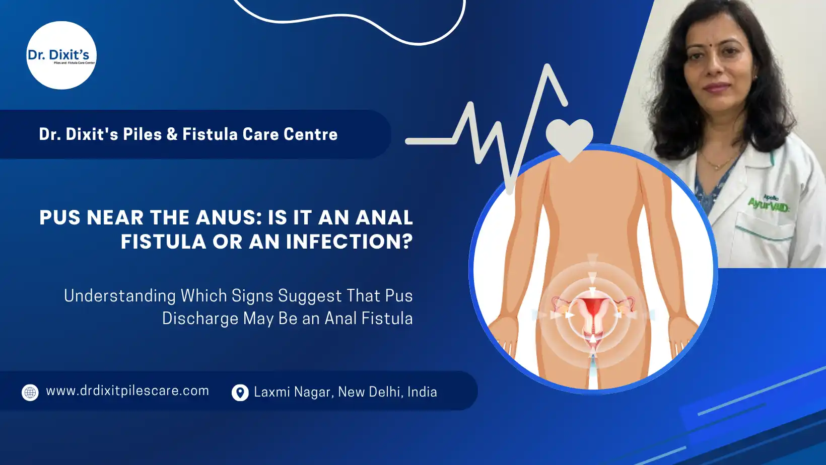Pus Near the Anus: Is It an Anal Fistula or an Infection?